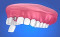 Tooth implant and crown installation process. Medically accurate 3D illustration