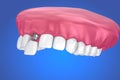 Tooth implant and crown installation process