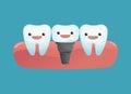 Tooth implant