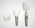 Tooth implant disassembled - (3d rendering) Royalty Free Stock Photo