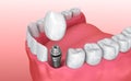 Tooth implant instalation process , Medically accurate 3D illustration Royalty Free Stock Photo