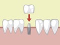 A tooth implant on a metal pin, a illustration with molar prostheses on the gum for an orthodontist or dentist