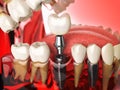 Tooth implant in the model human teeth, gums and denturas. Dental medicine stomatology concept. Royalty Free Stock Photo