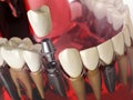 Tooth implant in the model human teeth, gums and denturas. Dental medicine stomatology concept.