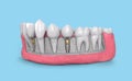 Tooth implant model in jaw 3d illustration