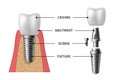 Tooth implant. Realistic implant structure pictorial models crown. Abutment, screw denture orthodontic implantation Royalty Free Stock Photo