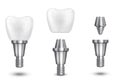 Tooth implant vector illustration