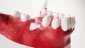 Tooth implantation picture series 7 of 13 - 3D Rendering