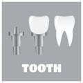 Tooth implants and normal Royalty Free Stock Photo