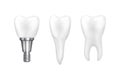 Tooth implants and normal tooth on white background Royalty Free Stock Photo