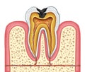 Tooth inner anatomy of a cavity Royalty Free Stock Photo