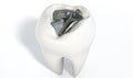 Tooth With Lead Filling Royalty Free Stock Photo