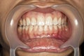 Tooth macro