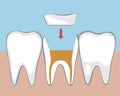 Tooth microprosthetics, Flat vector stock illustration with Canal treatment, molar depulpation and Ceramic orthodontic inlay Royalty Free Stock Photo