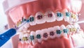 Tooth model from dental braces with inter dental teeth cleaning brush Royalty Free Stock Photo