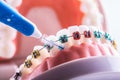 Tooth model from dental braces with inter dental teeth cleaning brush