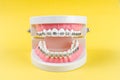 Tooth model with metal wire dental braces and equipment