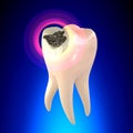 Tooth Molar with Dental Caries