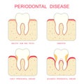 Tooth periodontal disease,