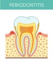 Tooth with periodontitis