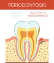 Tooth with periodontosis