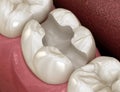 Tooth preparation for inlay placement. Medically accurate 3D illustration of human teeth