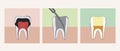 Tooth Pulpitis Treatment Process, Flat Vector Stock Illustration, Collage or Banner Set with Molar Depulpation with Caries, Royalty Free Stock Photo