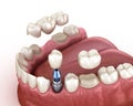 Tooth recovery with implant and crown. Medically accurate illustration dental concept