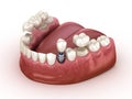 Tooth recovery with implant and crown. Medically accurate illustration dental concept