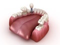 Tooth recovery with implant and crown. Medically accurate 3D illustration dental concept