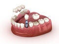 Tooth recovery with implant and crown. Medically accurate 3D illustration dental concept