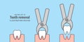 Tooth removal illustration vector on blue background. Dental