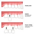 Tooth replacement dental medical vector illustration isolated on white background