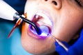 Tooth restoration with filling and polymerization lamp. Dental curing light setting composite resins. Royalty Free Stock Photo