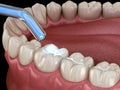 Tooth restoration with filling and polymerization lamp. Medically accurate tooth 3D illustration