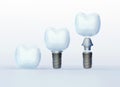 Tooth Crown and Tooth Implants