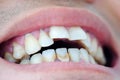 Tooth`s a man smoking bad. Man smokes a cigarettes have tooth decay and calculus on teeth, So we should be care dental with the Royalty Free Stock Photo