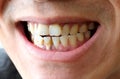 Tooth`s a man smoking bad. Man smokes a cigarettes have tooth decay and calculus on teeth, So we should be care dental with the Royalty Free Stock Photo