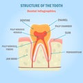 Tooth structure color infographics. Dental illustration for web and mobile design