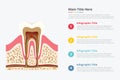 Tooth structure infographic with some point title description for information template - vector Royalty Free Stock Photo