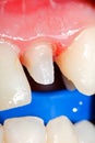 Tooth stub for crown