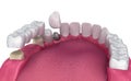 Tooth supported fixed bridge, implant and crown. Medically accurate illustration