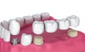 Tooth supported fixed bridge, implant and crown. Medically accurate