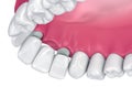 Tooth supported fixed bridge. Medically accurate 3D illustration