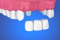 Tooth supported fixed bridge. Medically accurate