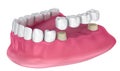 Tooth supported fixed bridge. Medically accurate