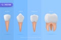 Tooth 34 Royalty Free Stock Photo