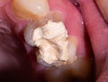 Tooth with temporary filling for nerve destruction and pulpitis treatment, macro. Dentistry