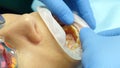 Tooth treatment. Closeup shot of female dentist assistant in gloves putting on installing sterile mouth expander