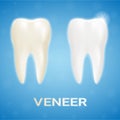 Tooth Veneer Whitening Dental Technician On A Background. Realistic Vector Illustration.